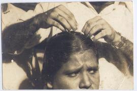Acupuncture